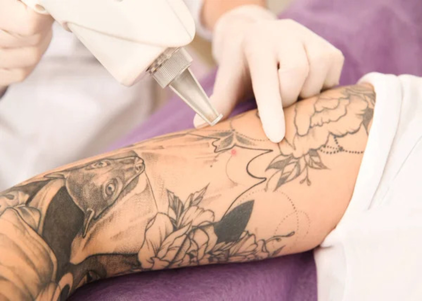 Top Boston Tattoo Removal Clinics for Safe and Effective Results.